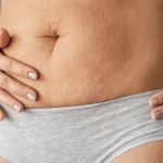 Wiotka skóra po odchudzaniu lub ciąży? Jak skutecznie przywrócić jej jędrność i elastyczność