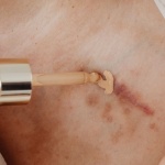 Mikroślady, wielka zmiana: roślinne serum, które krok po kroku wygładza blizny atroficzne