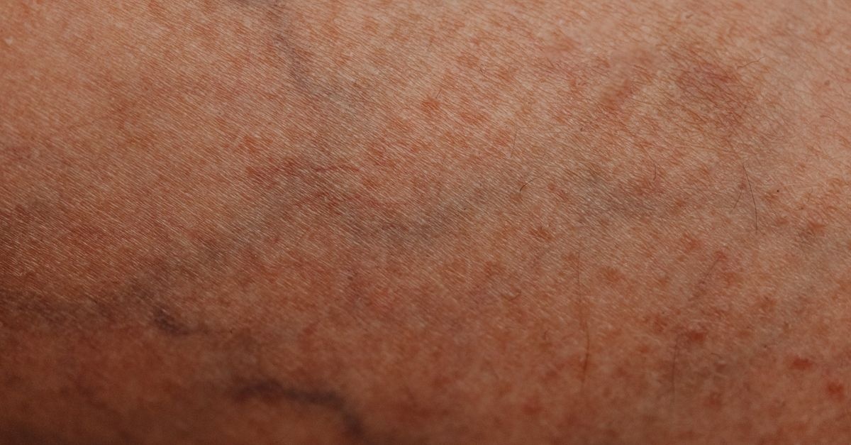 Koniec z wiecznym rumieńcem: jak opanować rumień (erytrozę) naczynkową — od pielęgnacji po profesjonalne terapie